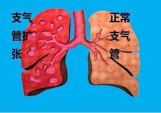 支气管扩张最新治疗策略与方案